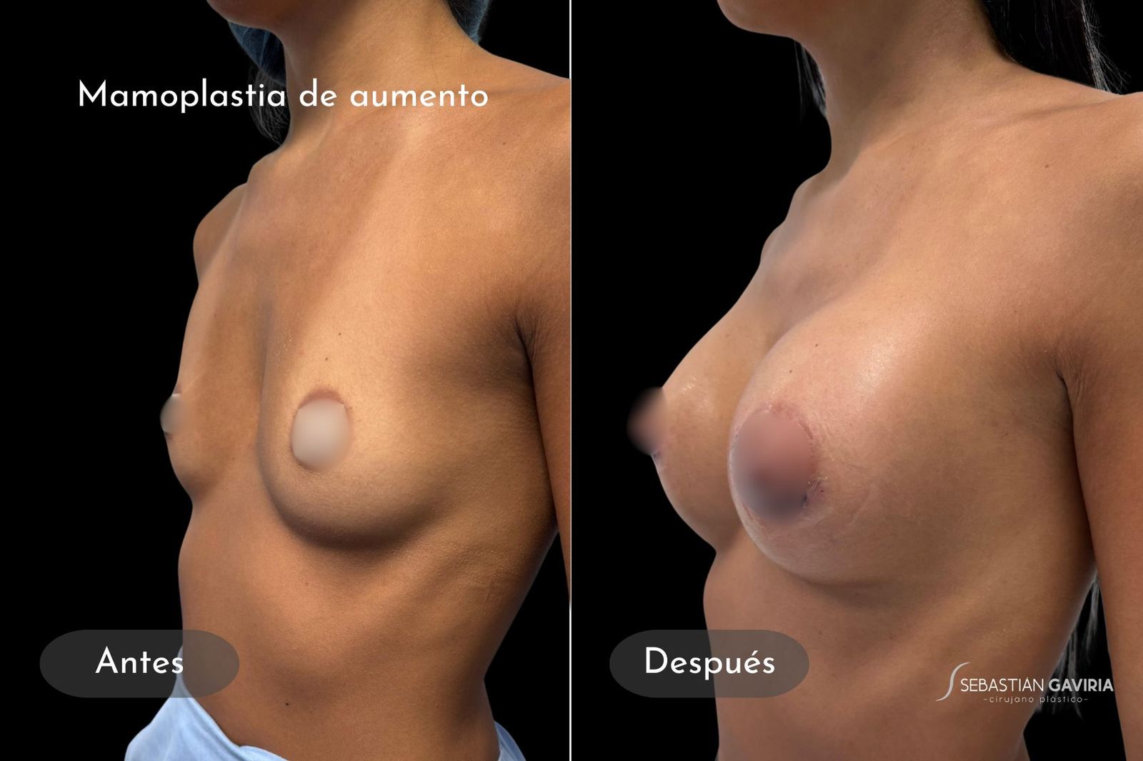 Resultado real de mamoplastia de aumento con el Dr. Sebastián Gaviria Posada, cirujano plástico en Medellín
