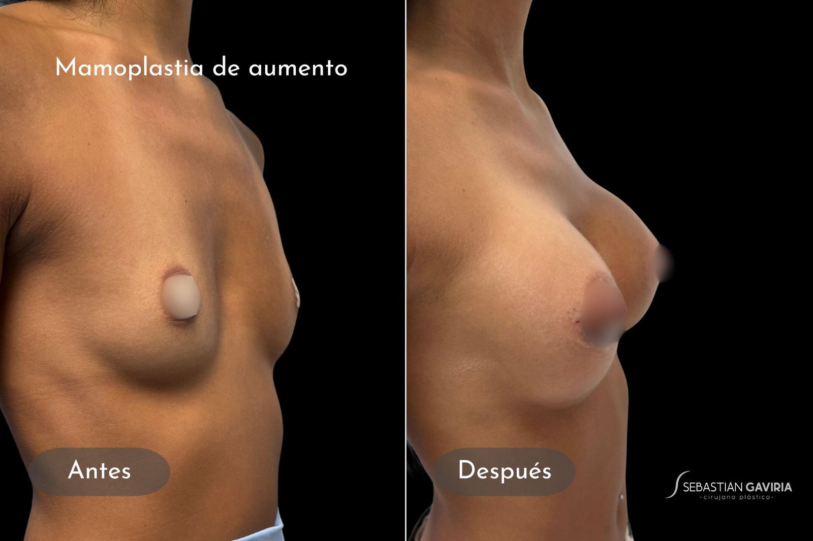 Resultado real de mamoplastia de aumento con el Dr. Sebastián Gaviria Posada, cirujano plástico en Medellín