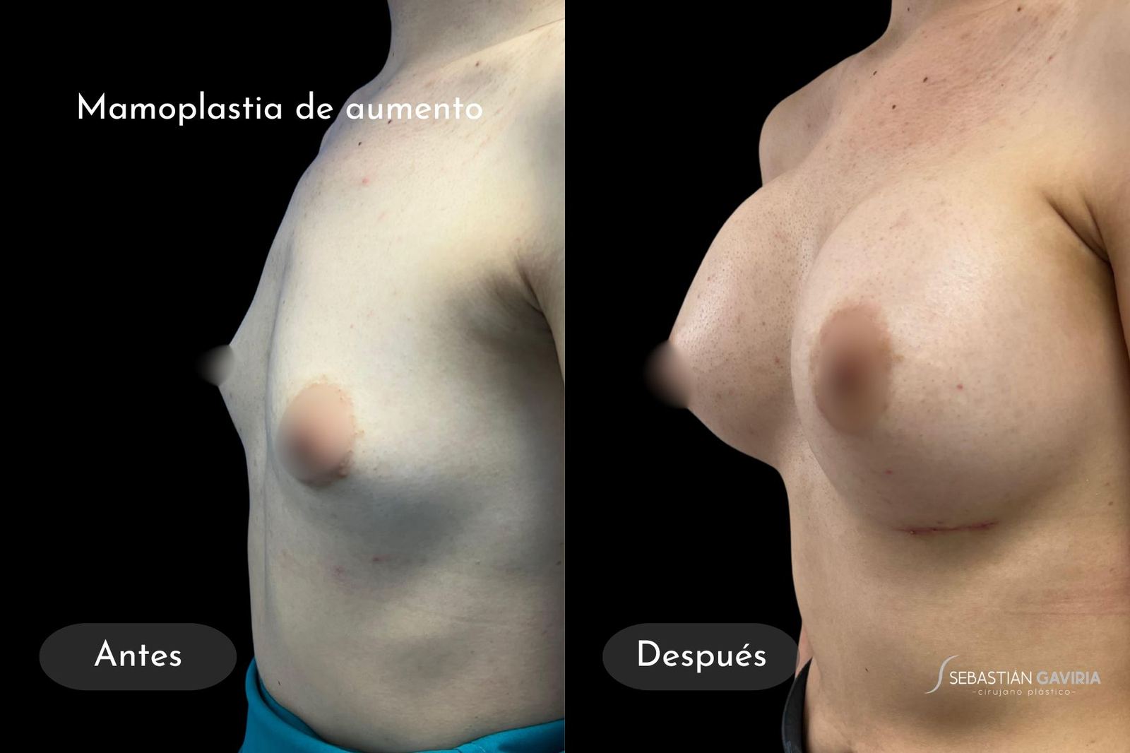 Resultado real de mamoplastia de aumento con el Dr. Sebastián Gaviria Posada, cirujano plástico en Medellín