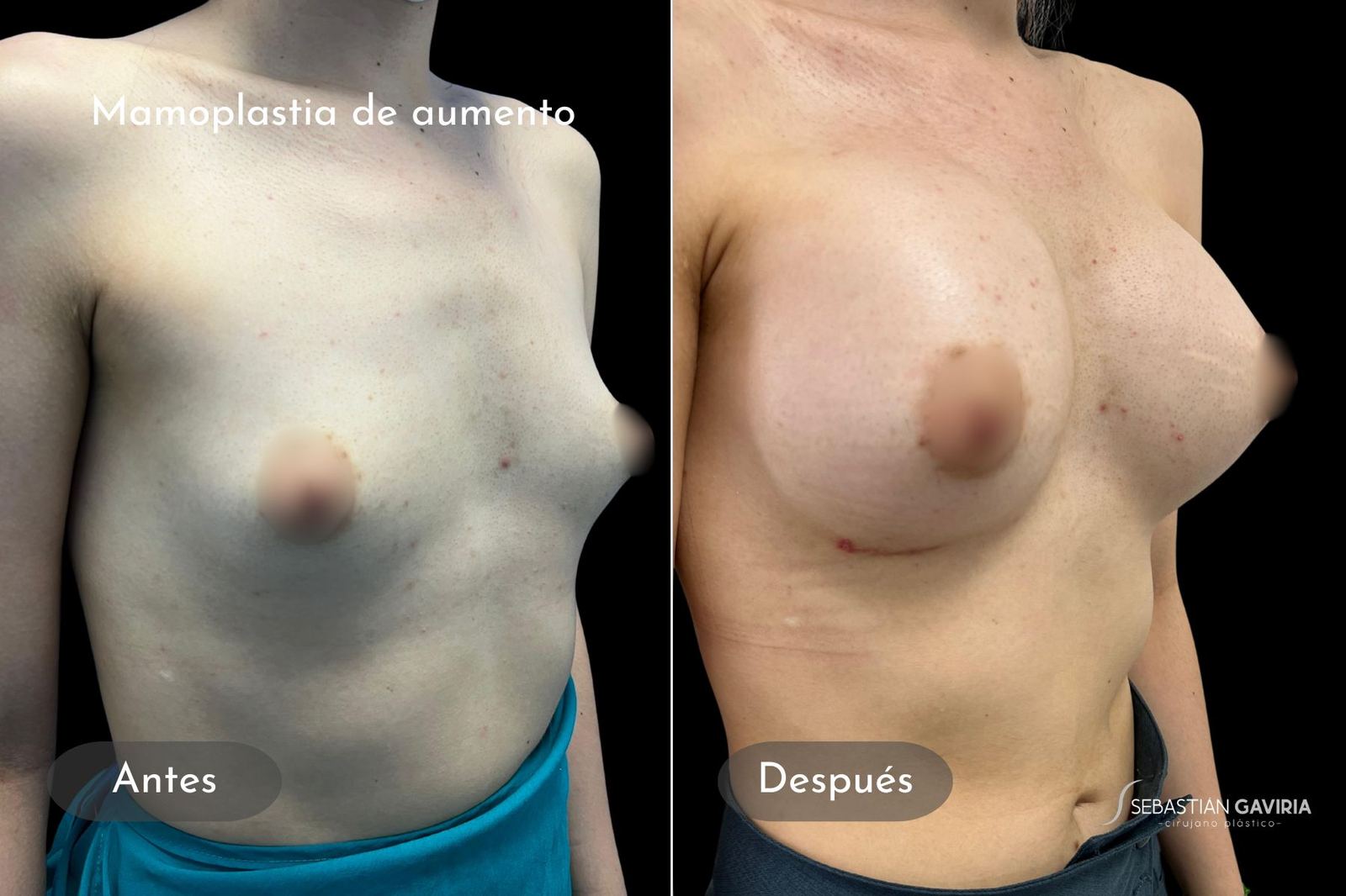 Resultado real de mamoplastia de aumento con el Dr. Sebastián Gaviria Posada, cirujano plástico en Medellín