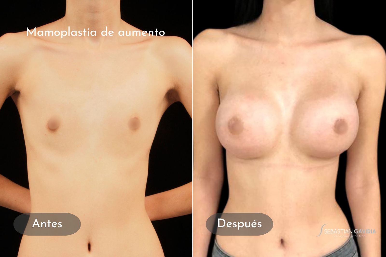 Resultado real de mamoplastia de aumento con el Dr. Sebastián Gaviria Posada, cirujano plástico en Medellín