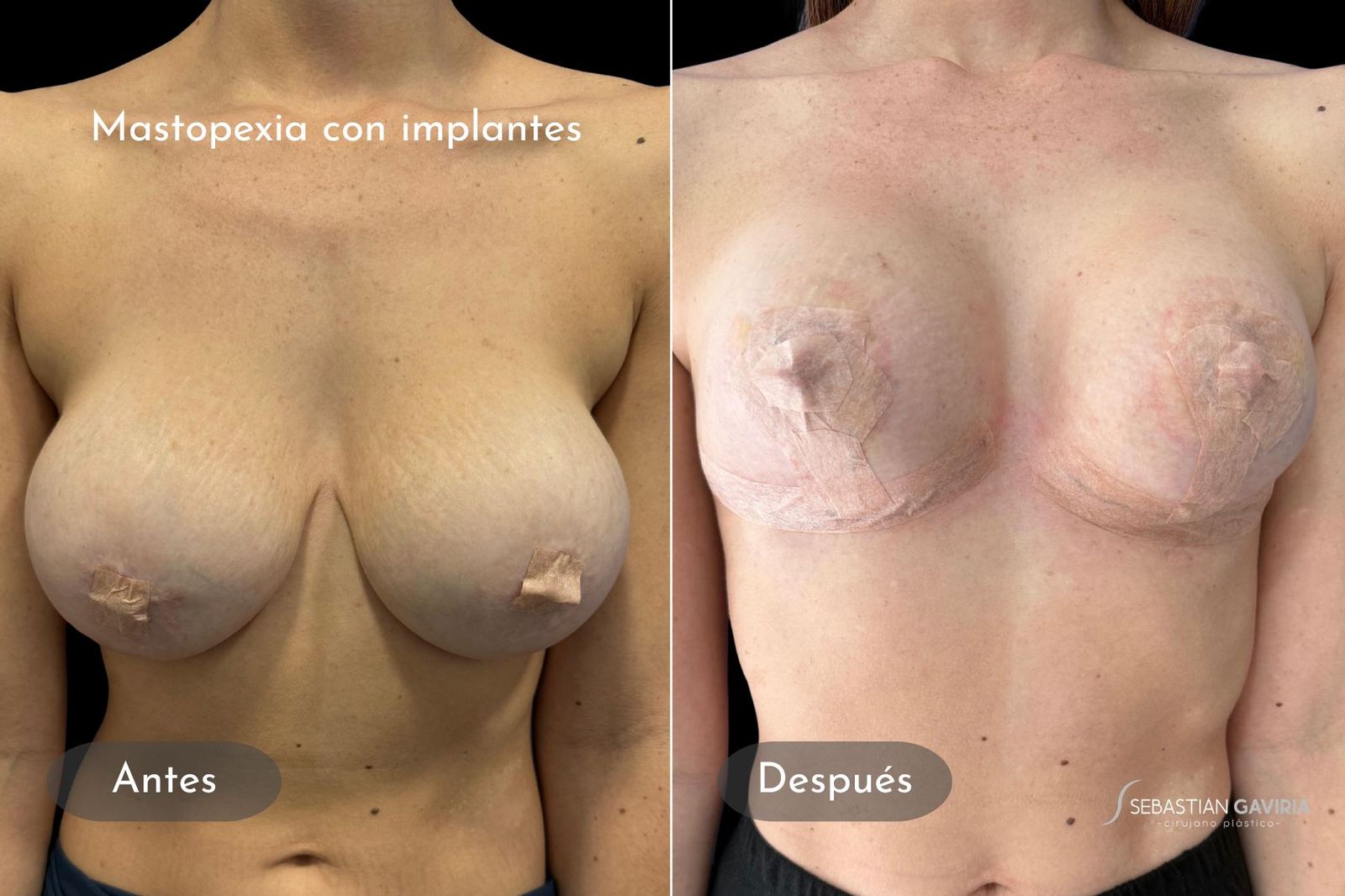 Resultado real de mastopexia con implantes con el Dr. Sebastián Gaviria Posada, cirujano plástico en Medellín