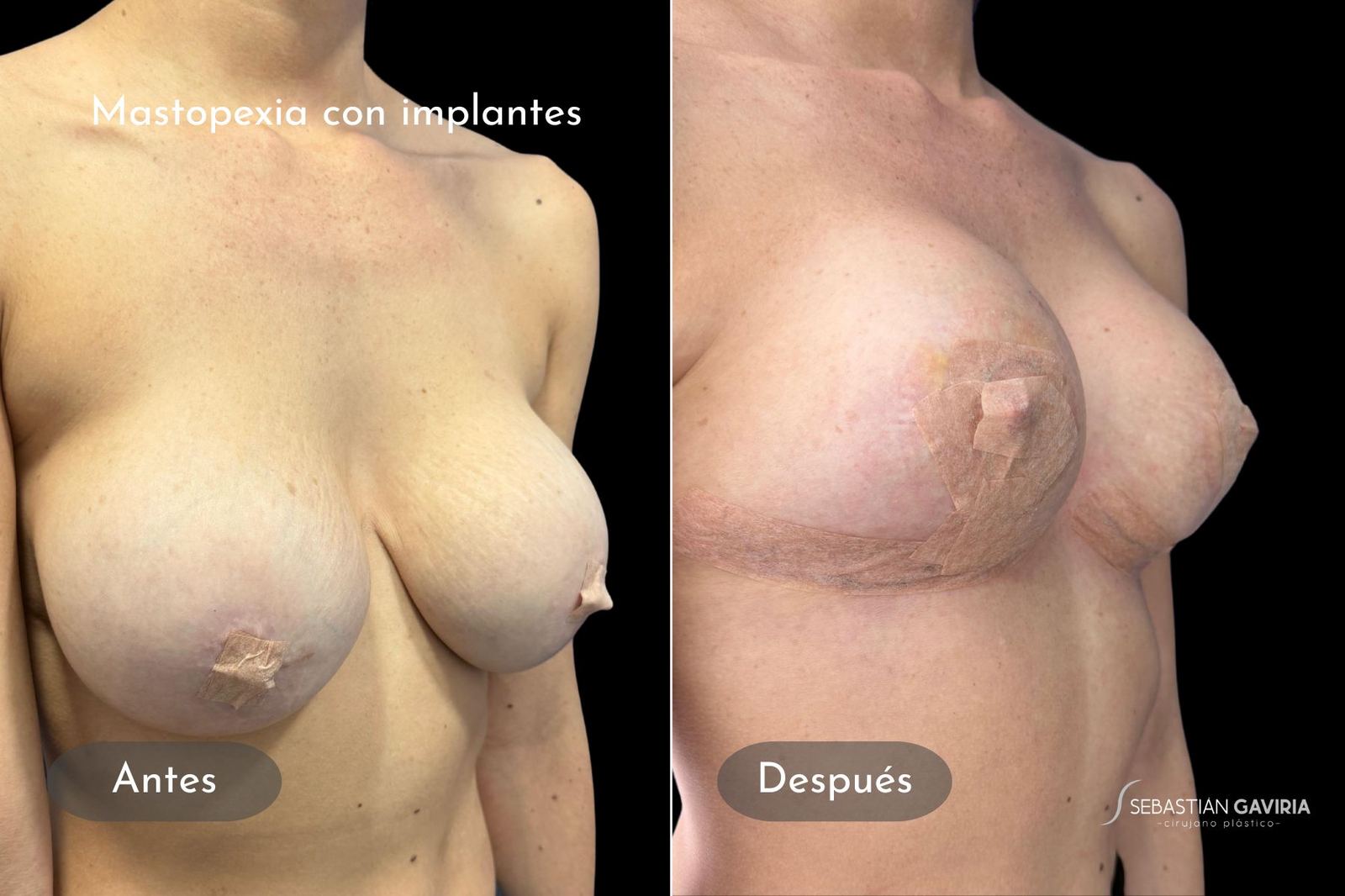 Resultado real de mastopexia con implantes con el Dr. Sebastián Gaviria Posada, cirujano plástico en Medellín