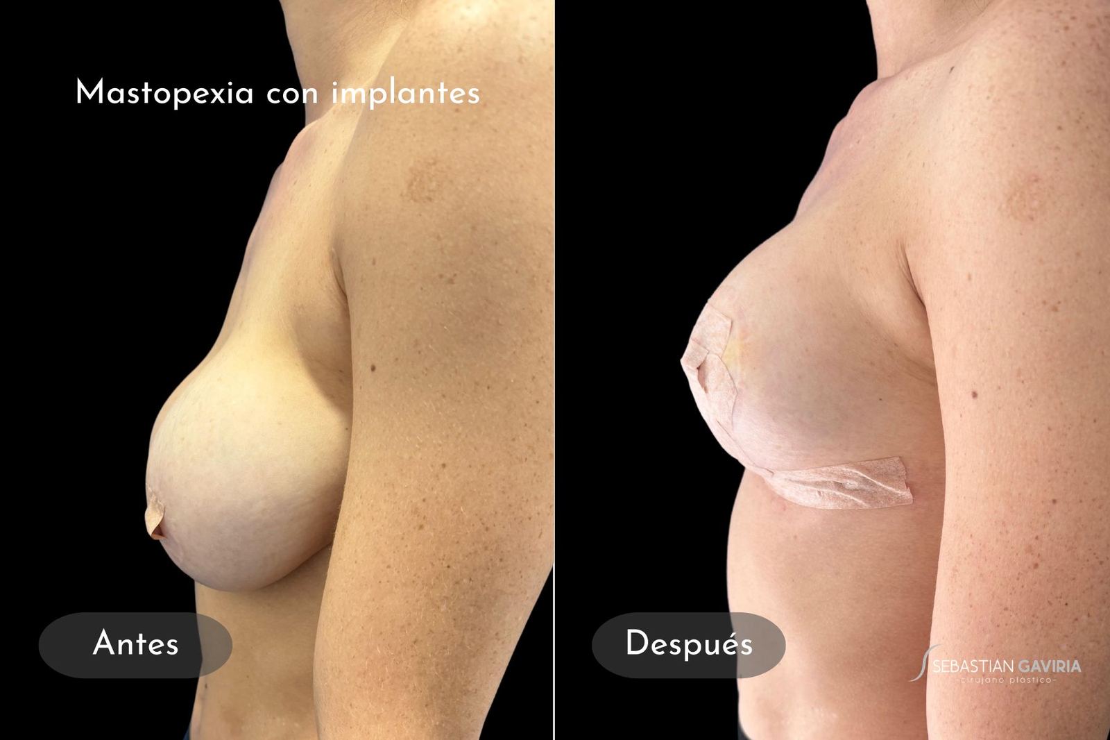 Resultado real de mastopexia con implantes con el Dr. Sebastián Gaviria Posada, cirujano plástico en Medellín