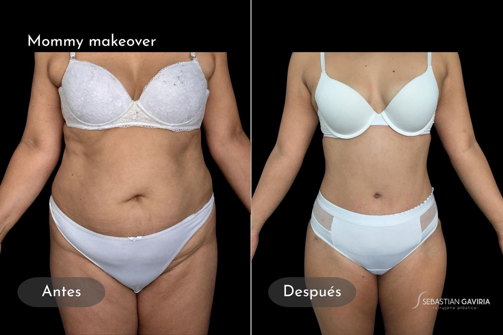 Resultado real de mommy makeover con el Dr. Sebastián Gaviria Posada, cirujano plástico en Medellín