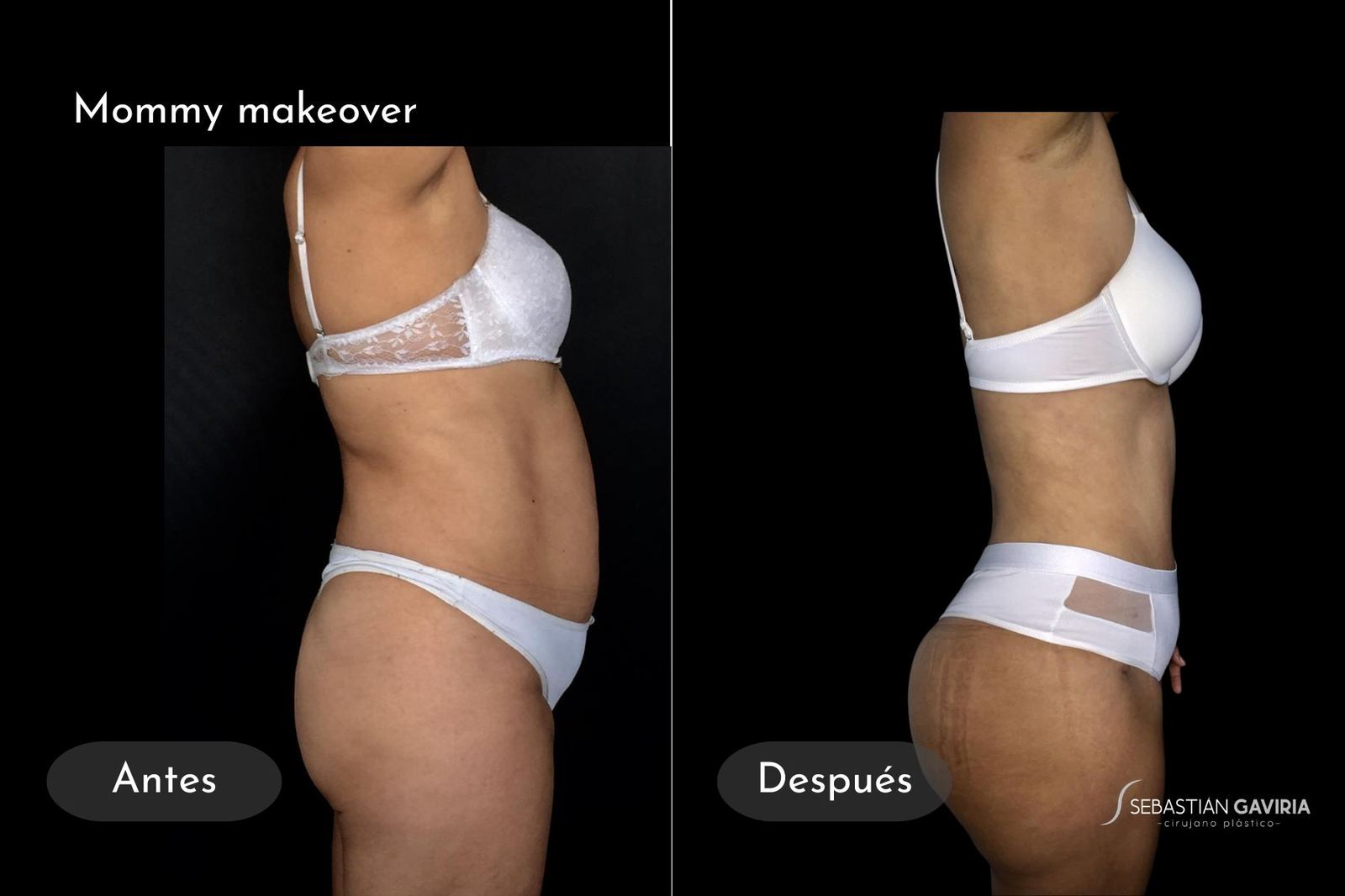 Resultado real de mommy makeover con el Dr. Sebastián Gaviria Posada, cirujano plástico en Medellín