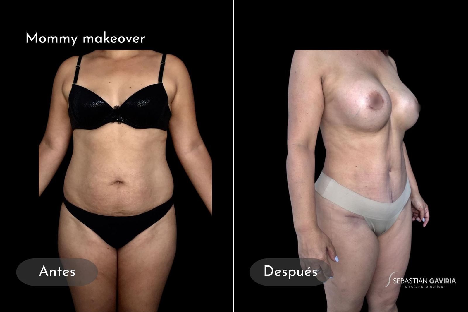 Resultado real de mommy makeover con el Dr. Sebastián Gaviria Posada, cirujano plástico en Medellín
