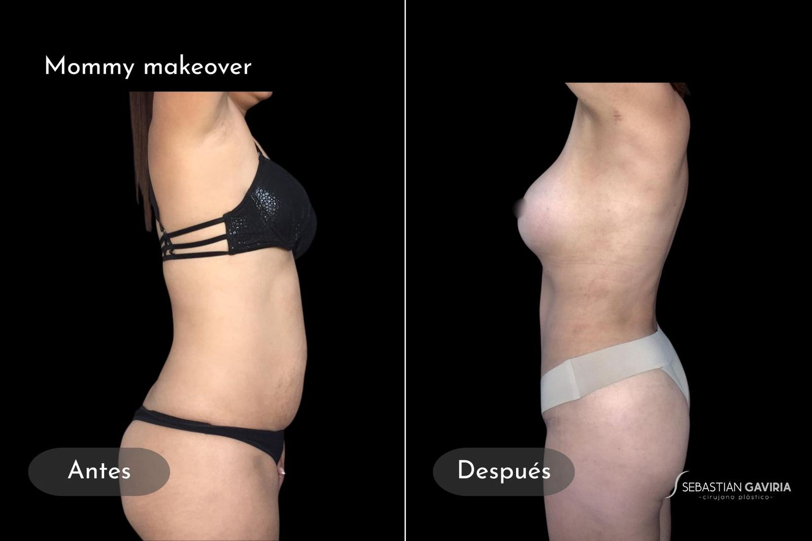 Resultado real de mommy makeover con el Dr. Sebastián Gaviria Posada, cirujano plástico en Medellín