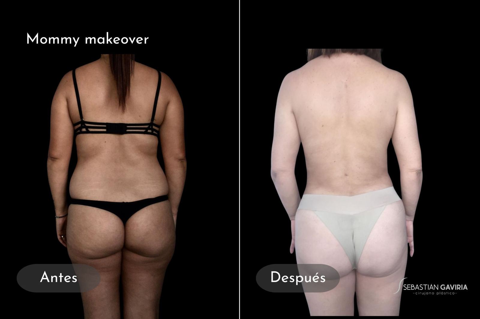Resultado real de mommy makeover con el Dr. Sebastián Gaviria Posada, cirujano plástico en Medellín