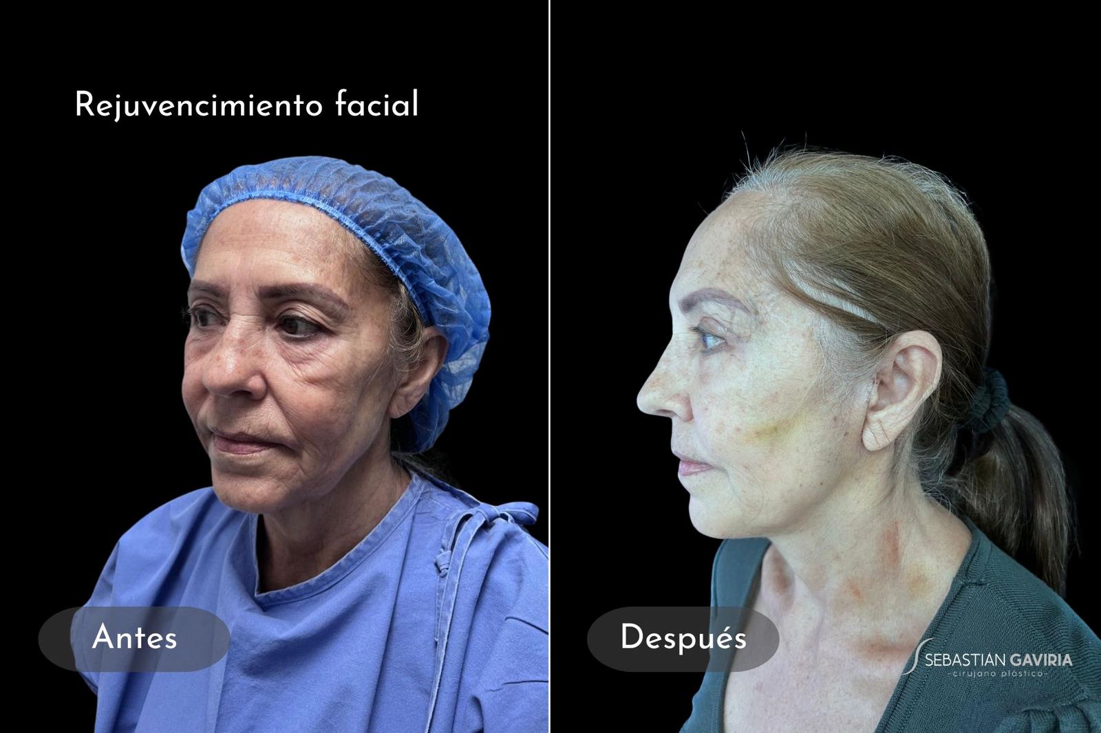 Resultado real de rejuvenecimiento facial con el Dr. Sebastián Gaviria Posada, cirujano plástico en Medellín