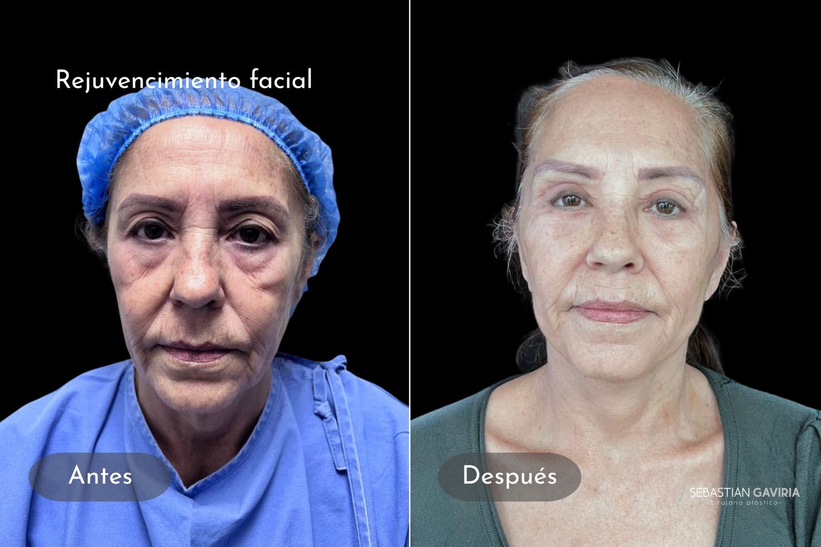 Resultado real de rejuvenecimiento facial con el Dr. Sebastián Gaviria Posada, cirujano plástico en Medellín