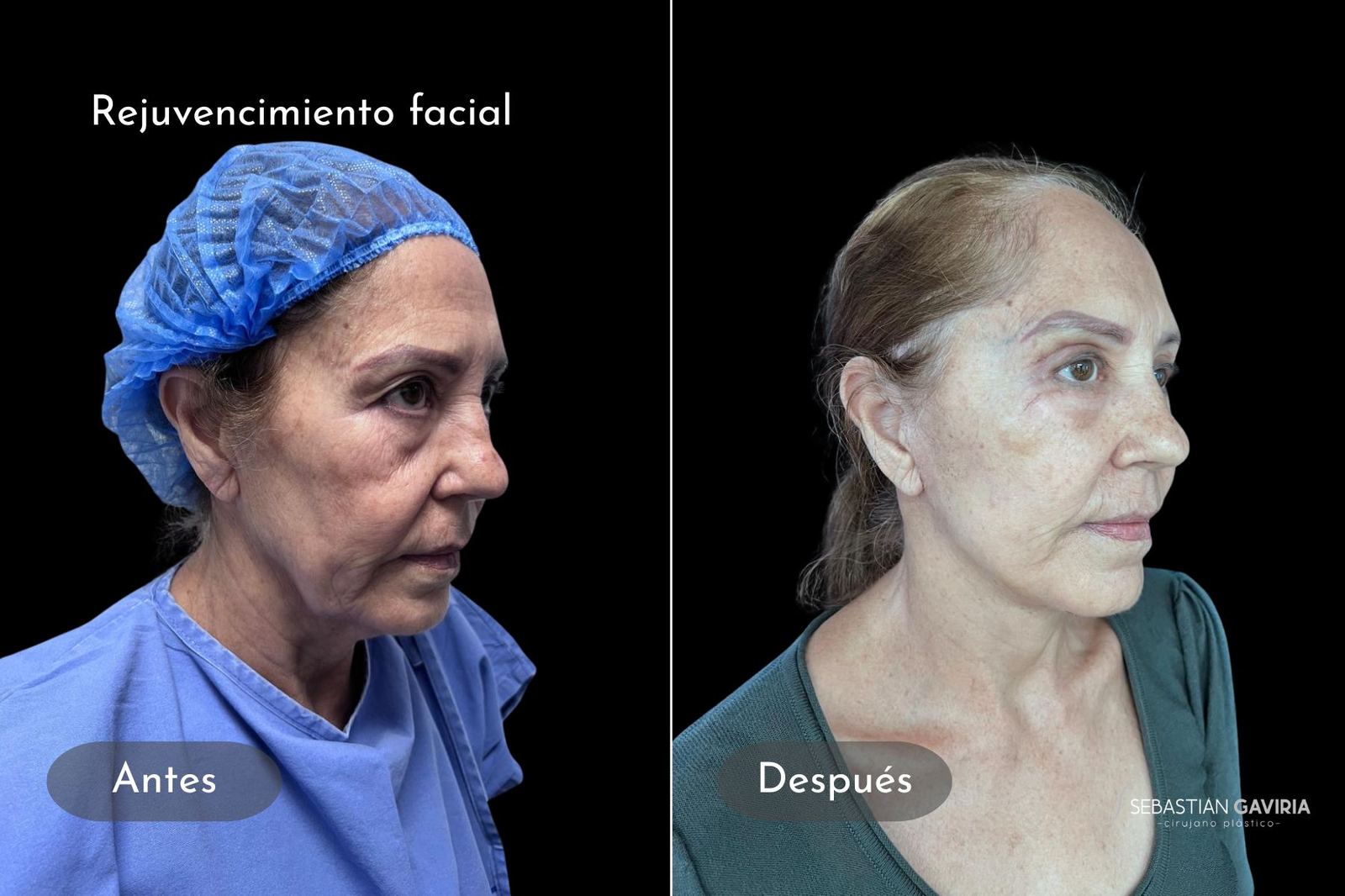 Resultado real de rejuvenecimiento facial con el Dr. Sebastián Gaviria Posada, cirujano plástico en Medellín