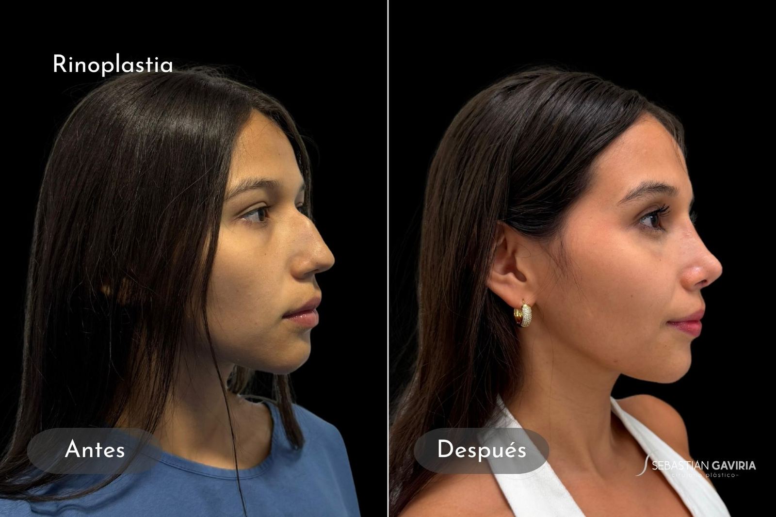 Resultado real de rinoplastia con el Dr. Sebastián Gaviria Posada, cirujano plástico en Medellín