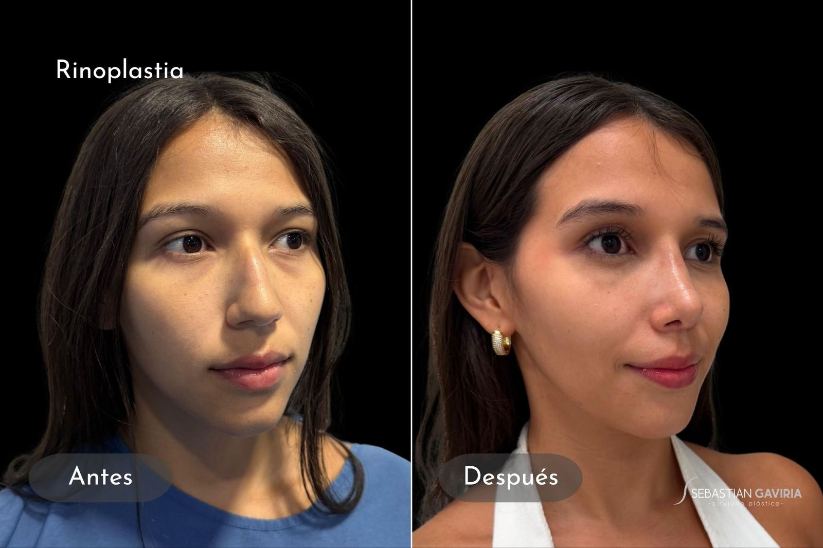 Resultado real de rinoplastia con el Dr. Sebastián Gaviria Posada, cirujano plástico en Medellín