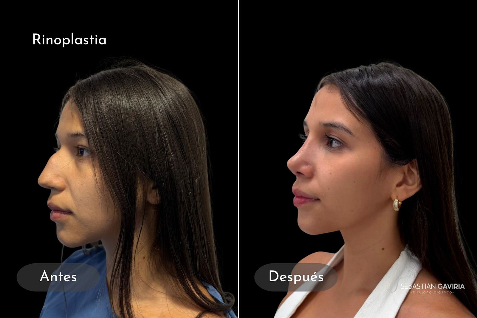 Resultado real de rinoplastia con el Dr. Sebastián Gaviria Posada, cirujano plástico en Medellín