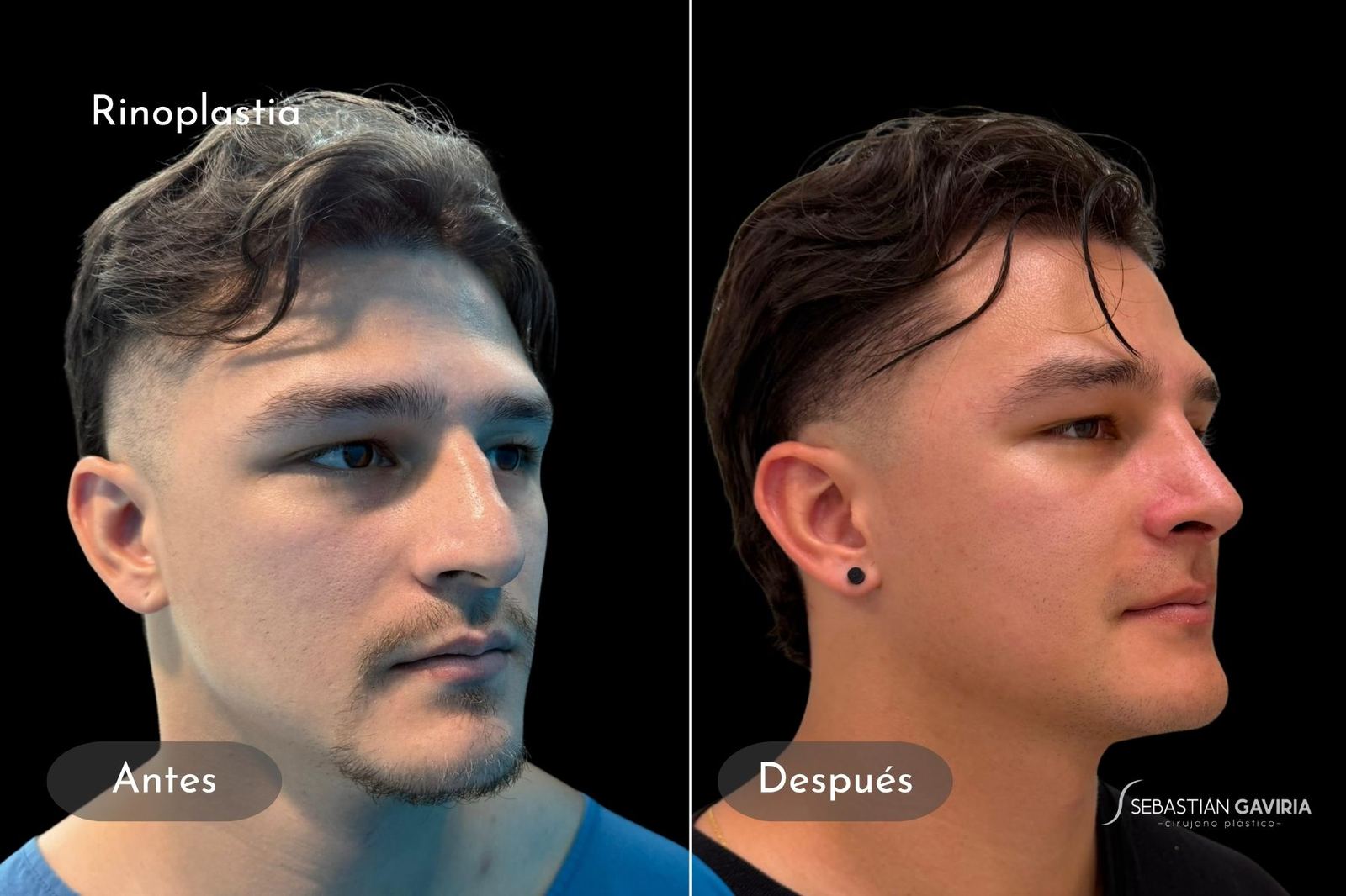 Resultado real de rinoplastia con el Dr. Sebastián Gaviria Posada, cirujano plástico en Medellín