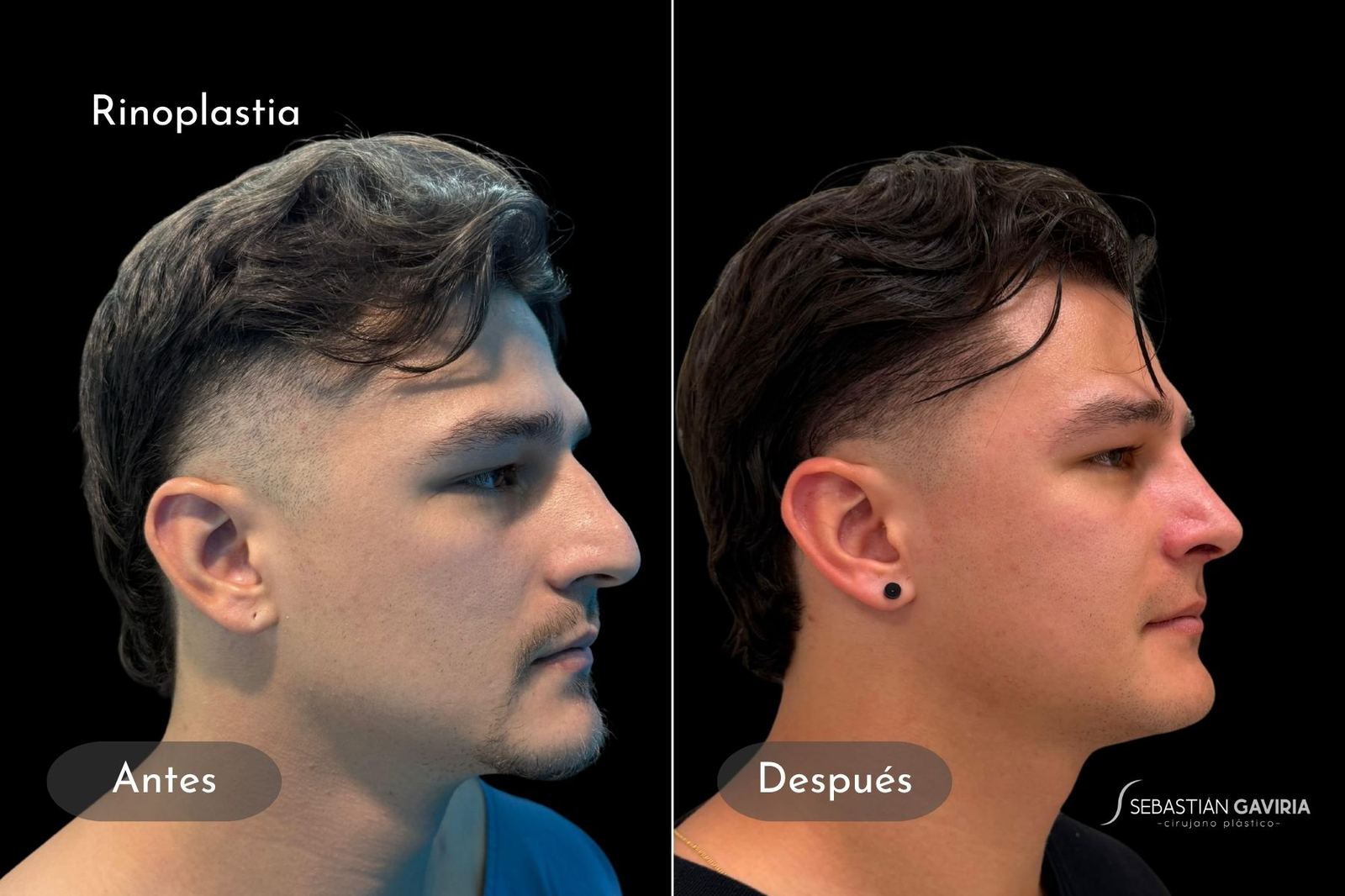 Resultado real de rinoplastia con el Dr. Sebastián Gaviria Posada, cirujano plástico en Medellín