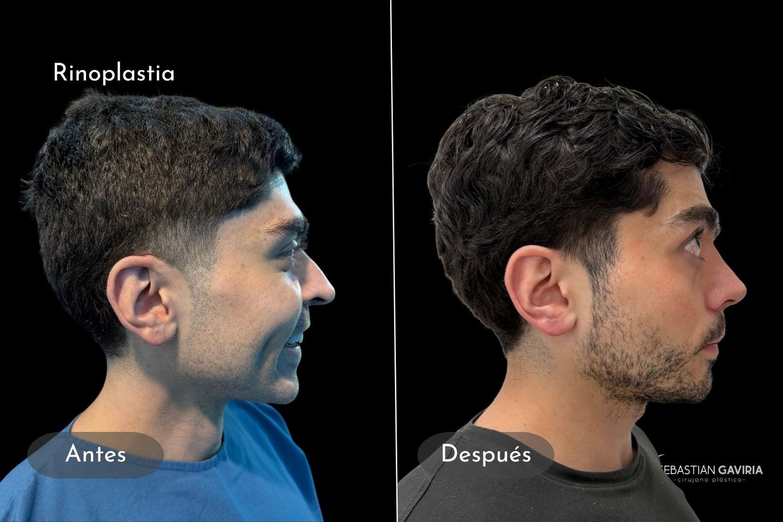Resultado real de rinoplastia con el Dr. Sebastián Gaviria Posada, cirujano plástico en Medellín
