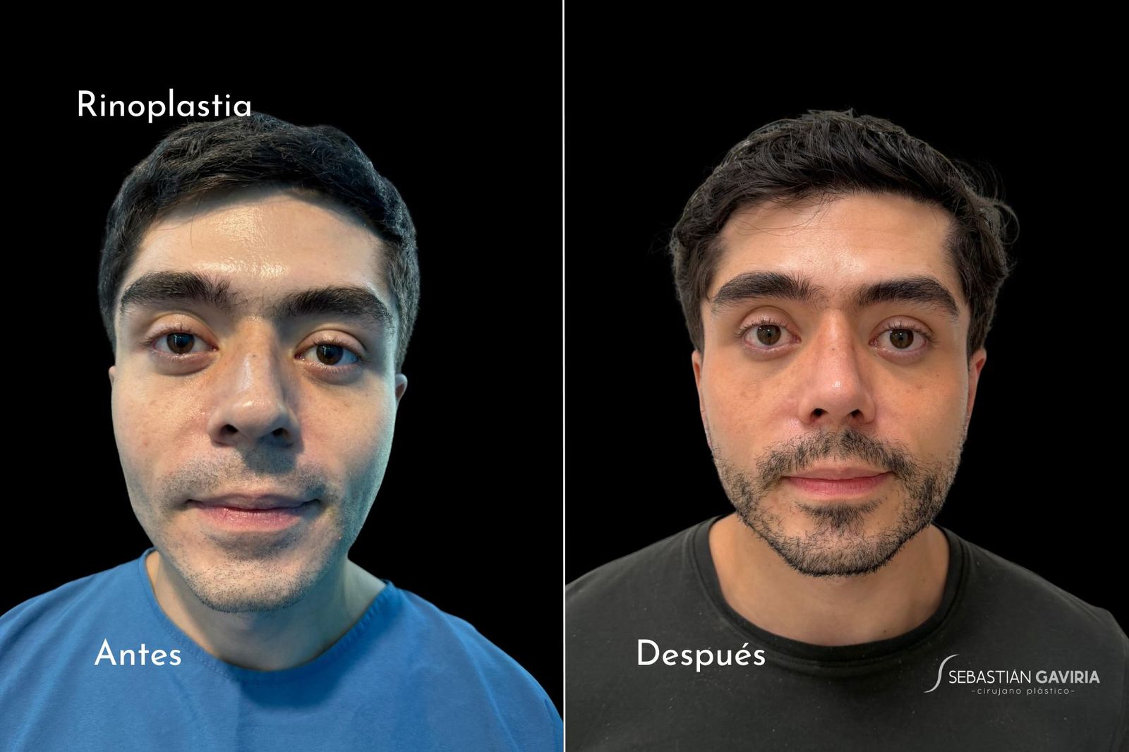 Resultado real de rinoplastia con el Dr. Sebastián Gaviria Posada, cirujano plástico en Medellín