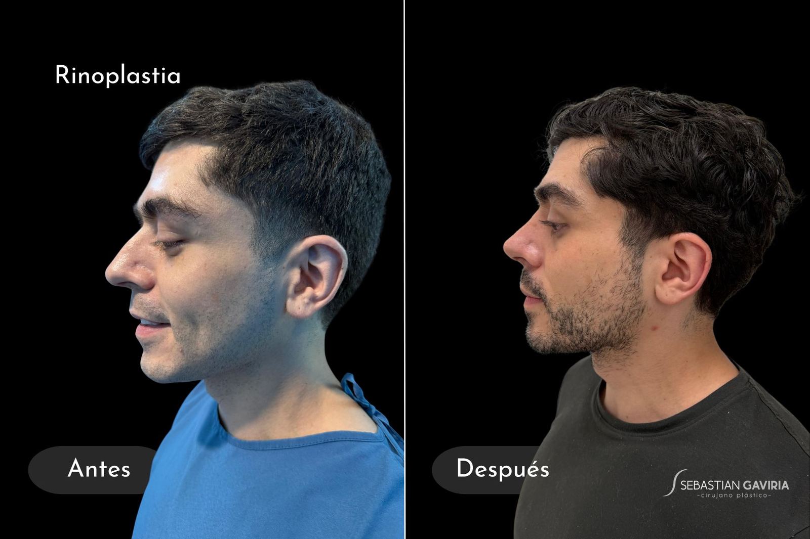 Resultado real de rinoplastia con el Dr. Sebastián Gaviria Posada, cirujano plástico en Medellín